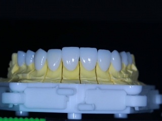PHỤC HÌNH RĂNG SỨ NACERA